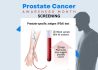 prostate-specific antigen, or PSA
