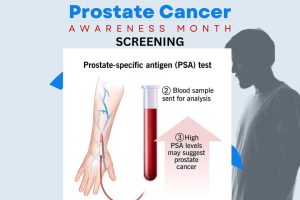 prostate-specific antigen, or PSA